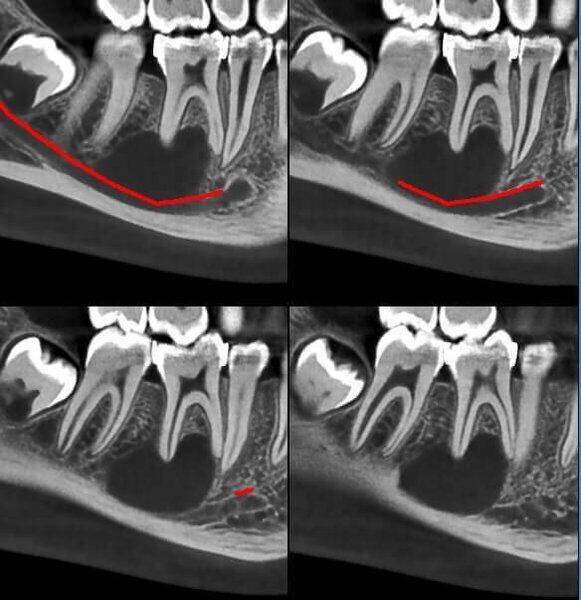 5G XL MED_Immagini Diagnostiche_TESTA E COLLO_DENTIZIONE_Cisti mandibolare in Q4_4