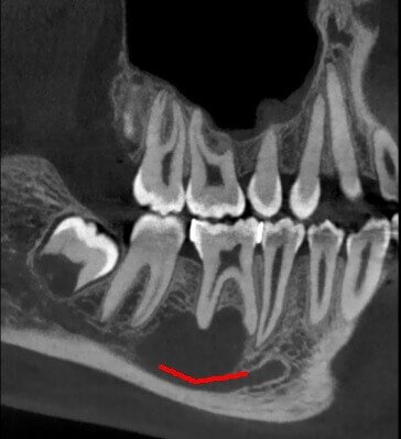 5G XL MED_Immagini Diagnostiche_TESTA E COLLO_DENTIZIONE_Cisti mandibolare in Q4_5