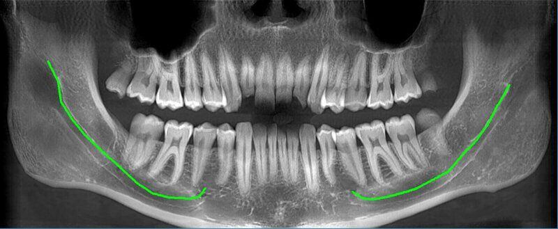5G XL MED_Immagini Diagnostiche_TESTA E COLLO_DENTIZIONE_Doppia arcata_1