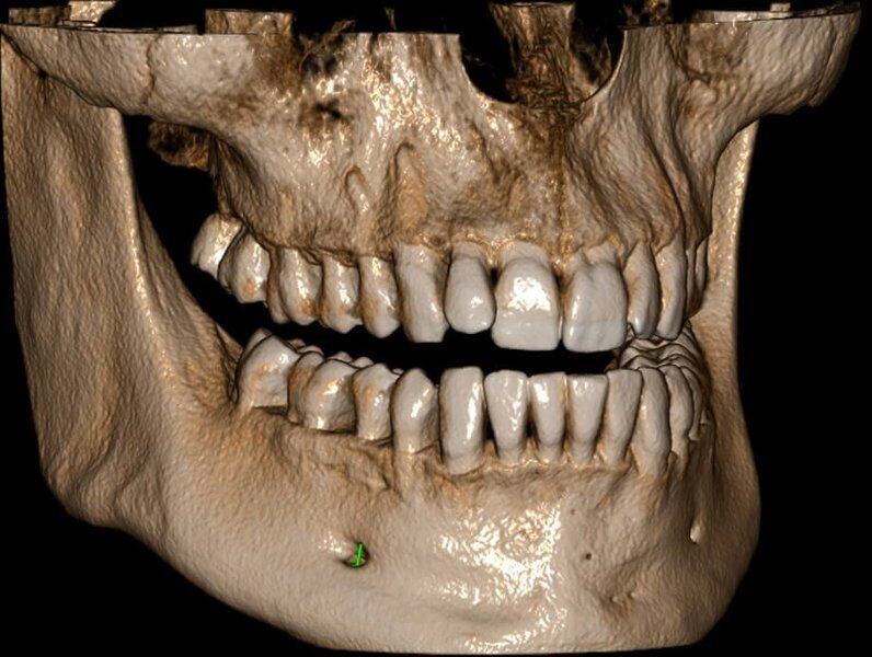 5G XL MED_Immagini Diagnostiche_TESTA E COLLO_DENTIZIONE_Doppia arcata_6