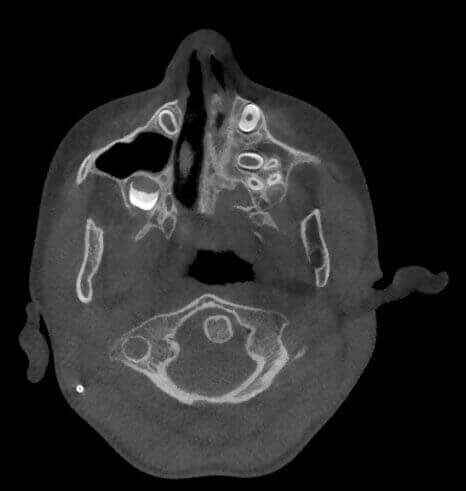 5G XL MED_Immagini Diagnostiche_TESTA E COLLO_MAXILLO-FACCIALE_Acquisizione Maxiillofacciale per valutazione chirurgica di paziente con Sindrome di Goldenhar_2