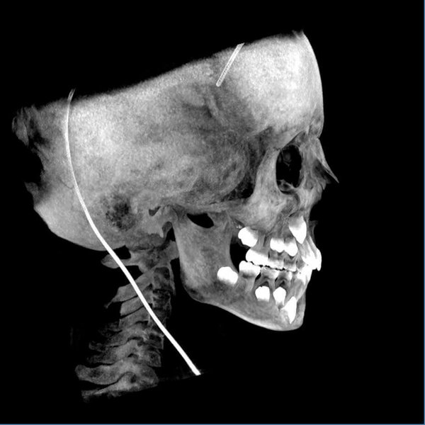 5G XL MED_Immagini Diagnostiche_TESTA E COLLO_MAXILLO-FACCIALE_Acquisizione Maxiillofacciale per valutazione chirurgica di paziente con Sindrome di Goldenhar_4