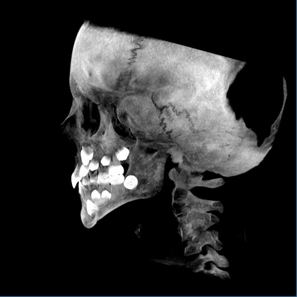 5G XL MED_Immagini Diagnostiche_TESTA E COLLO_MAXILLO-FACCIALE_Acquisizione Maxiillofacciale per valutazione chirurgica di paziente con Sindrome di Goldenhar_5