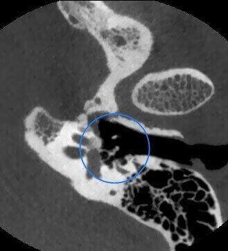 5G XL MED_Immagini Diagnostiche_TESTA E COLLO_OTORINOLARINGOIATRIA_Catena Ossiculare e Nervo Facciale_1