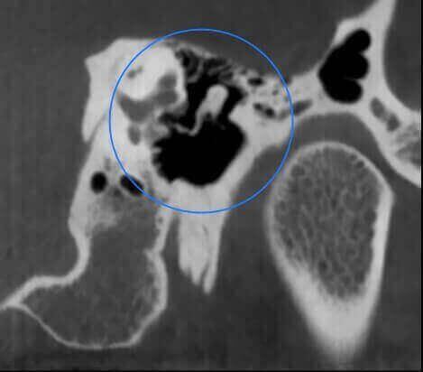 5G XL MED_Immagini Diagnostiche_TESTA E COLLO_OTORINOLARINGOIATRIA_Catena Ossiculare e Nervo Facciale_2