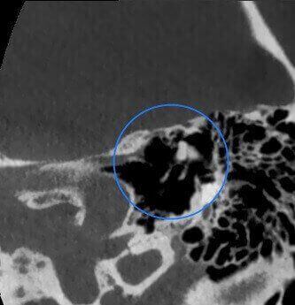 5G XL MED_Immagini Diagnostiche_TESTA E COLLO_OTORINOLARINGOIATRIA_Catena Ossiculare e Nervo Facciale_3