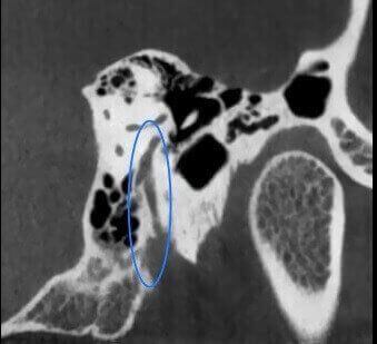 5G XL MED_Immagini Diagnostiche_TESTA E COLLO_OTORINOLARINGOIATRIA_Catena Ossiculare e Nervo Facciale_4
