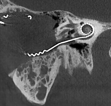 5G XL MED_Immagini Diagnostiche_TESTA E COLLO_OTORINOLARINGOIATRIA_Impianto Cocleare_1