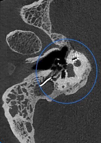 5G XL MED_Immagini Diagnostiche_TESTA E COLLO_OTORINOLARINGOIATRIA_Impianto Cocleare_2