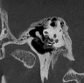 5G XL MED_Immagini Diagnostiche_TESTA E COLLO_OTORINOLARINGOIATRIA_Impianto Cocleare_3