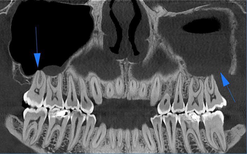 5G XL MED_Immagini Diagnostiche_TESTA E COLLO_SENI MASCELLARI_Rottura del pavimento del Seno Mascellare sinistro con Sinusite_1