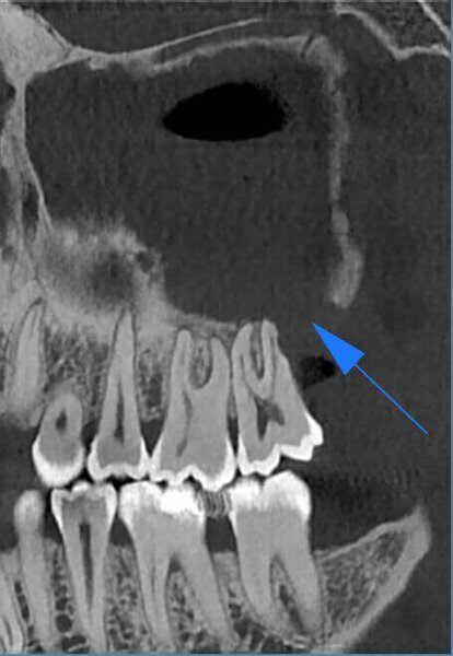 5G XL MED_Immagini Diagnostiche_TESTA E COLLO_SENI MASCELLARI_Rottura del pavimento del Seno Mascellare sinistro con Sinusite_2
