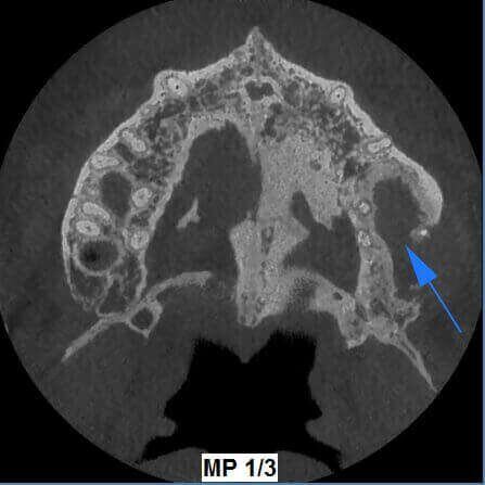 5G XL MED_Immagini Diagnostiche_TESTA E COLLO_SENI MASCELLARI_Rottura del pavimento del Seno Mascellare sinistro con Sinusite_3