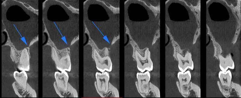 5G XL MED_Immagini Diagnostiche_TESTA E COLLO_SENI MASCELLARI_Rottura del pavimento del Seno Mascellare sinistro con Sinusite_4