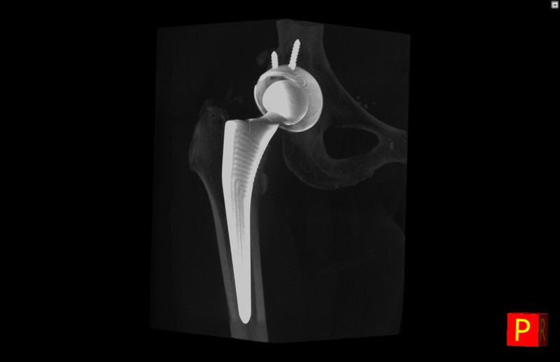 Follow up protesi dell'anca