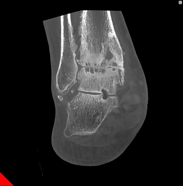 Osteoporosi articolare caviglia