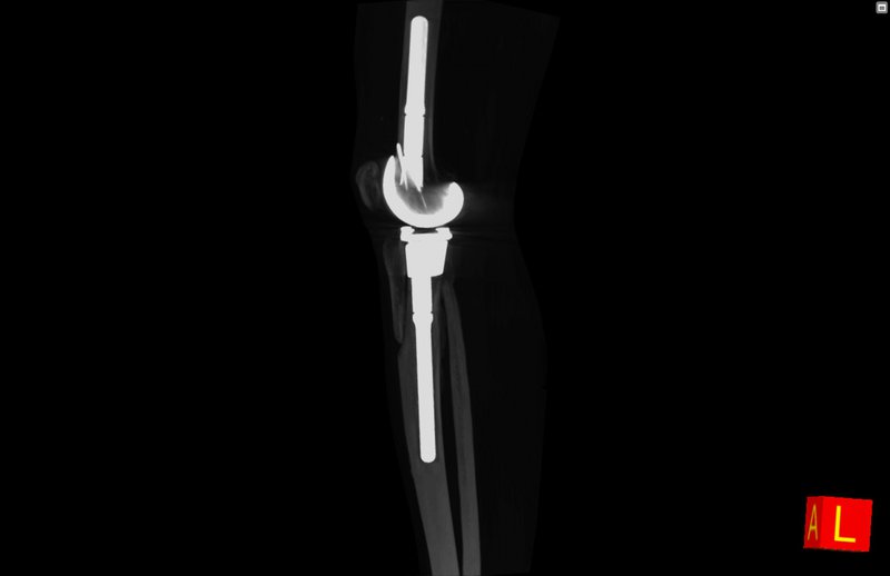 Protesi ginocchio intramidollare tibia-femore