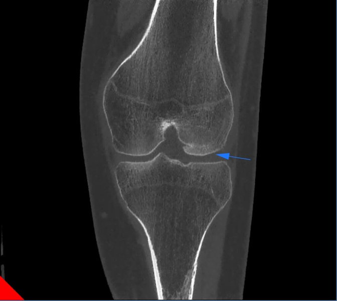 Lateral femoral condile fracture