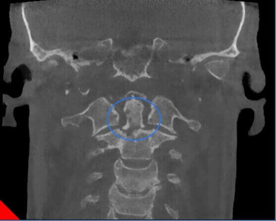 Cervical Spine: Dens fracture-Type II