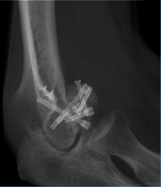 Capitulum and Troclea fracture with Ostesynthesis tool