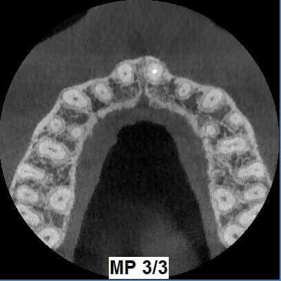 Trattamento Endodontico in Incisivo 2.1