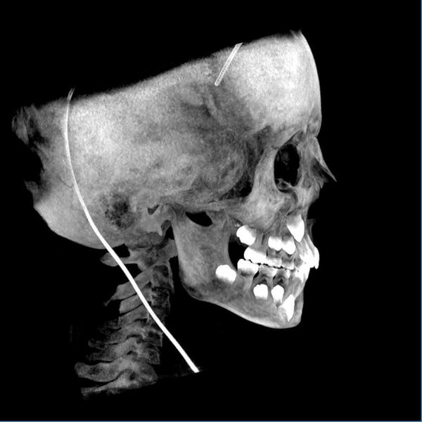 Maxillofacial acquisition for surgical evaluation in a patient with Goldenhar Syndrome