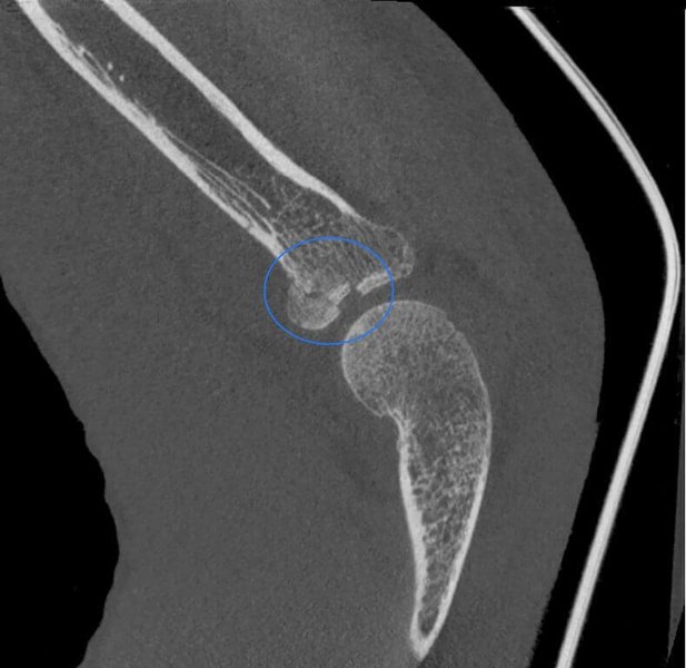 Radial Head fracture in patient with cast