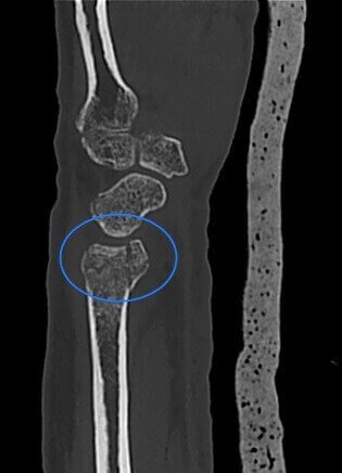 Radius Styloid process fracture