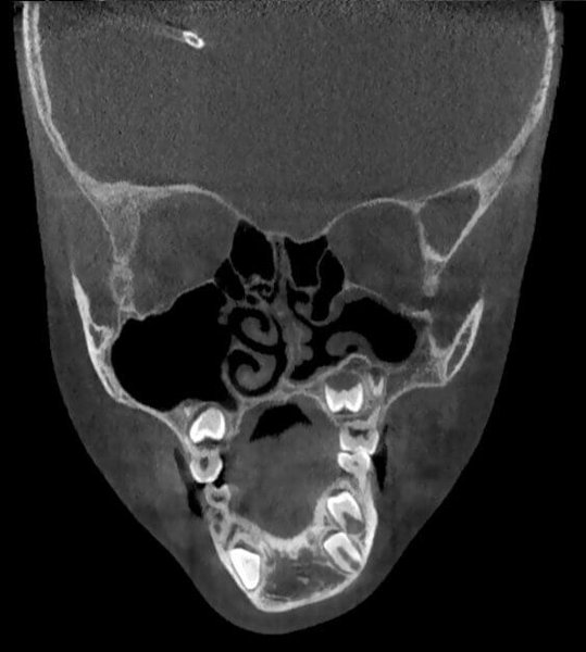 Maxillofacial acquisition for surgical evaluation in a patient with Goldenhar Syndrome