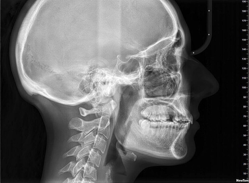 Radiografia Cefalometrica 2D