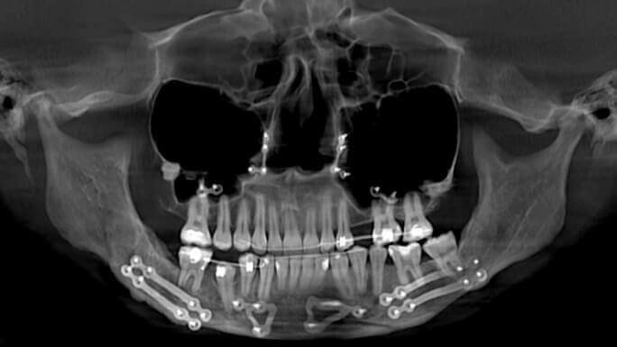 Acquisizione Maxillofacciale per trattamento Ortodontico e Ortognatico: follow up post operatorio