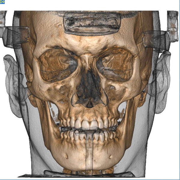 Maxillofacial acquisition and Airways evaluation