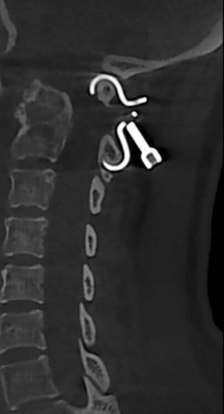 Cervical spine prosthesis in C1 - C2