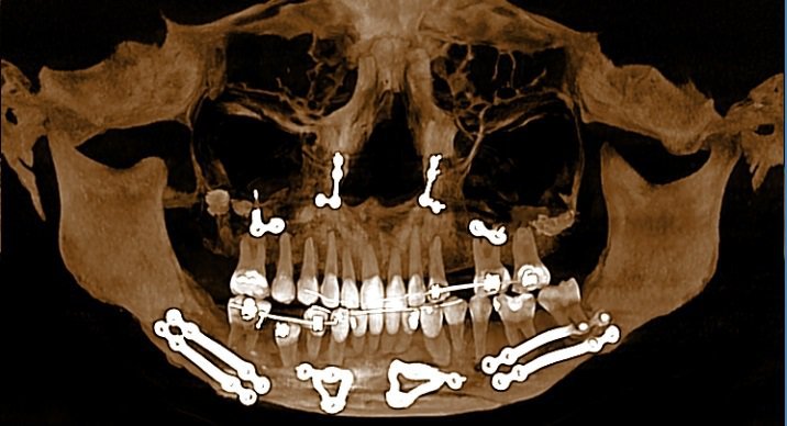 Maxillofacial acquisition for Orthodontic and Orthognatic pourposes: post surgery follow up