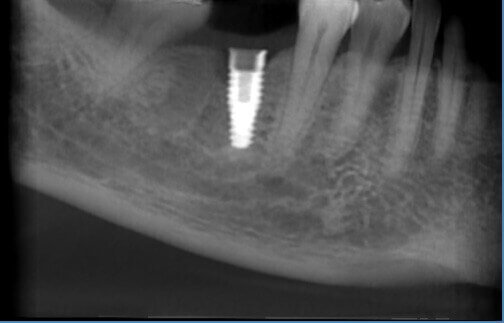 Implant follow up