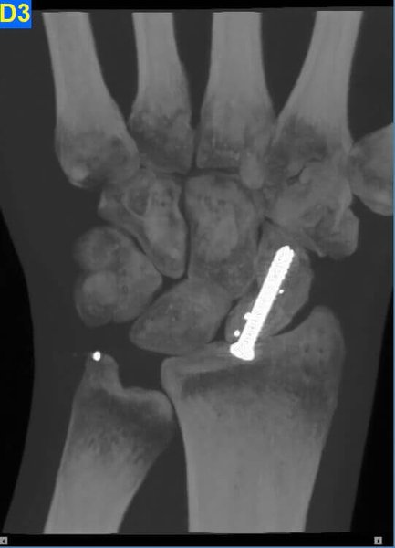 Scaphoid fracture with Ostesynthesis tool