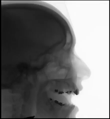 Temporo mandibular joint